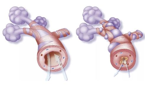 About chronic respiratory diseases such as asthma, bronchiectasis, and COPD !