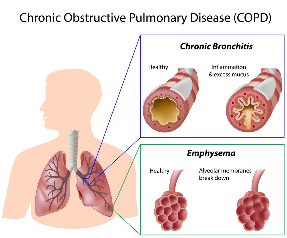 Nebulizing inhalation inhalation combined with non-invasive ventilation therapy in COPD