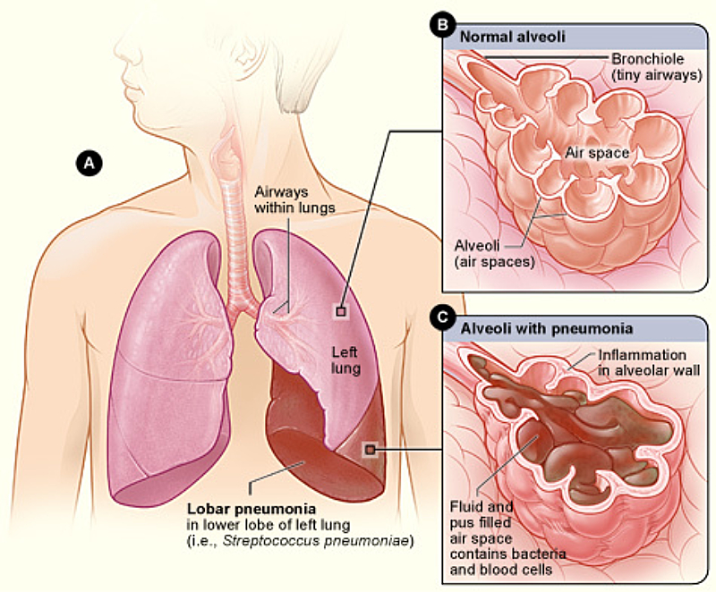 Pulmicort Respules combined with Ventolin nebulization treatment