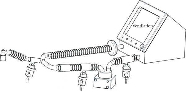 The Aerosol Delivery Location in Intubated and Mechanically Ventilated Patients